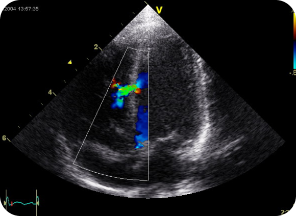 Echocardiogram